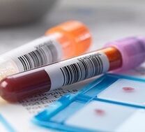 Diagnosis of prostatitis laboratory