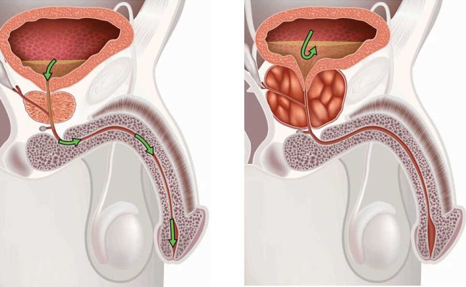 Prostatitis