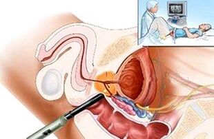 How to diagnose prostatitis
