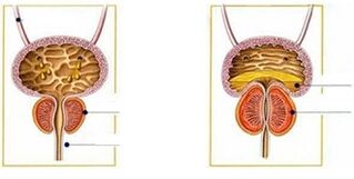 Types and types of prostatitis in men