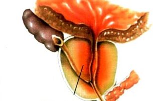 What is prostatitis in men