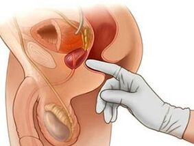 Prostate massage treats prostatitis in men