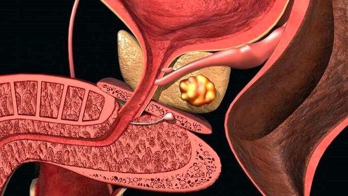 Stone deposition in the prostate when prostatitis is caused by stones