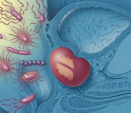Prostatitis