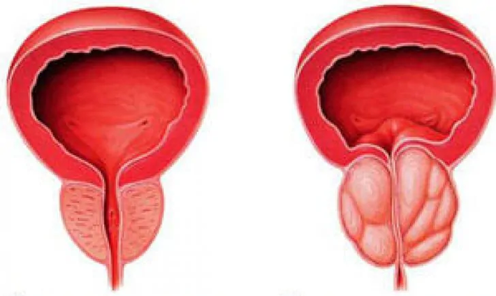 Normal prostate (left) and chronic prostatitis (right)